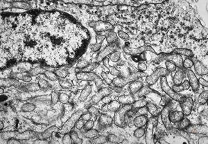 M, 54y. | pituitary adenoma - oncocytic